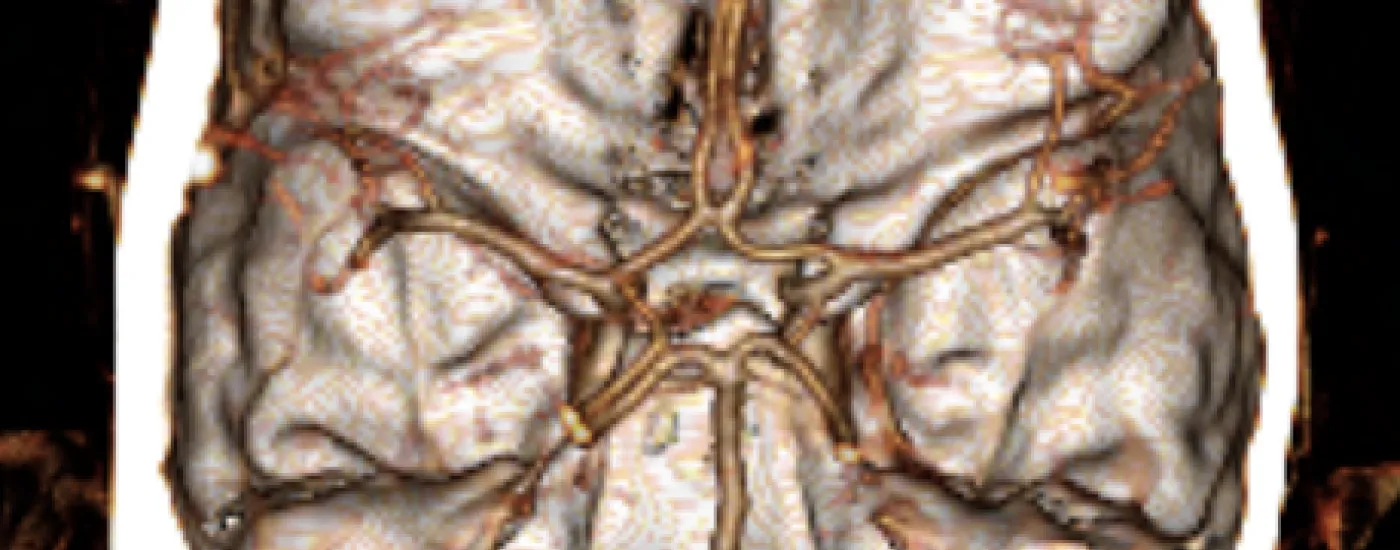 Neuroradiology image of brain